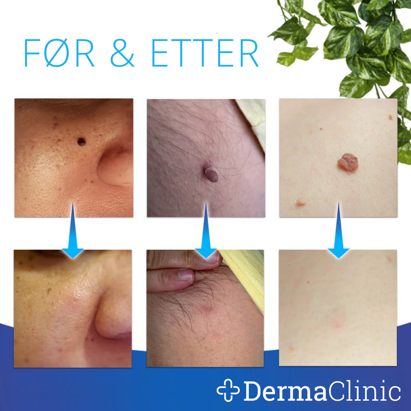 dermatag-smertfri-fjerning-av-hudtagger-dermaclinic